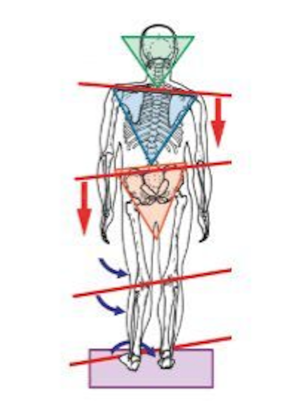 correctivestrategiesforscoliosis